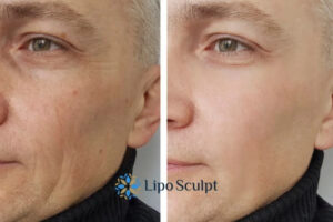 How to Fight Aging Symptoms 3 Fight Aging Symptoms Oxshott With HIFU and Morpheus8 Today!