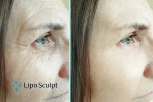 How to Fight Aging Symptoms 2 Do you want to Fight Aging Symptoms Oxshott? Contact Lipo Sculpt today!
