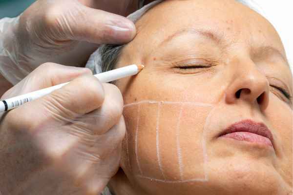 CryoPen: 5 Skin Concerns It May Be Used to Treat 4 What should you ask before having CryoPen treatment Oxshott?