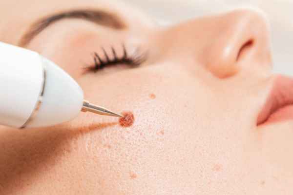 CryoPen: 5 Skin Concerns It May Be Used to Treat 3 What actually happens during a CryoPen treatment Oxshott?
