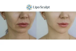 Explaining Total Skin Tightening Treatment And What It Can Do For You 2 Do you want to boost your self confidence? Give Morpheus8 Oxshott a try today!