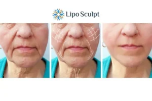 Explaining Total Skin Tightening Treatment And What It Can Do For You 3 Boost your confidence with Morpheus8 Oxshott call our team today!