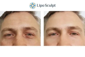 Explaining Total Skin Tightening Treatment And What It Can Do For You 6 Morpheus8 Oxshott book in today to find out more!