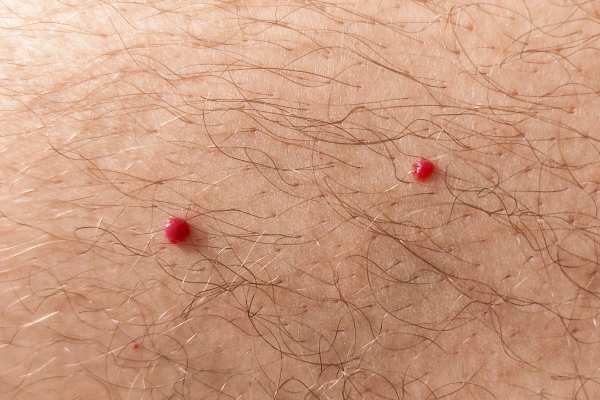 CryoPen: 5 Skin Concerns It May Be Used to Treat 2 cherry angioma removal Oxshott