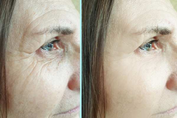 Why Do People Choose HIFU for a Non-Surgical Facelift? 4 How long can HIFU results last Oxshott?