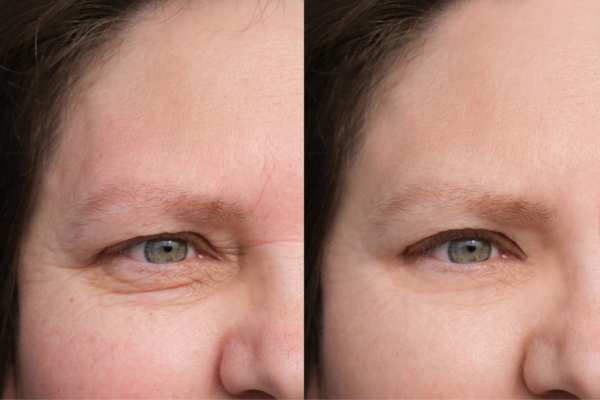 HIFU vs Botulinum Toxin: Understanding the Differences 4 How long do HIFU results last Oxshott?