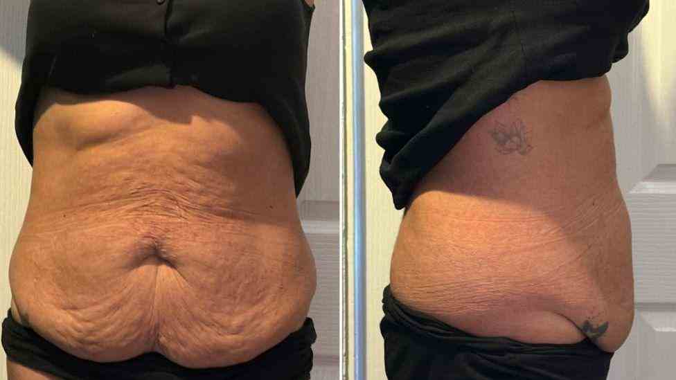 Lost the Weight but Not the Loose Skin? What You Should Know 1 Is It Definitely Loose Skin Oxshott?